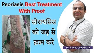 सोरायसिस का पूरा इलाज  Psoriasis Best Homeopathic Treatment  Best Homeopathic Doctor in India [upl. by Miriam]