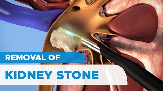 Removal of Kidney Stones Percutaneous Nephrolithotomy PCNL for Kidney Stones [upl. by Anaihr]