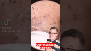 Crazy Satisfying BLACKHEAD REMOVAL shorts [upl. by Nirek]