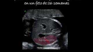 Infeccion Intrauterinawmv [upl. by Inram722]