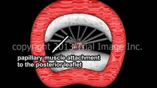 Mitral Valve Prolapse and Mitral Regurgitation by Dr Cal Shipley MD [upl. by Chlo]