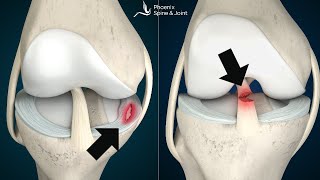 Is your knee pain coming from an ACL tear or Meniscus injury How to tell [upl. by Nandor]