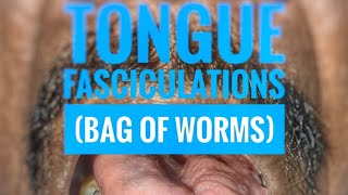 Tongue fasciculations quotBag of wormsquot  mbbs medicine neurology [upl. by Ahsir151]