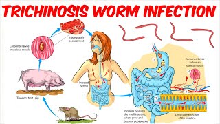 Trichinosis Trichinellosis Worm Infection [upl. by Assilla542]