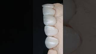 Maquillaje borde incisal disilicato de litio esteticadental dentist diente aidite [upl. by Adiam690]