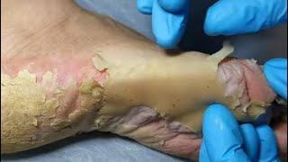 How to removal skin  callus removal skin flakes 53 [upl. by Lobell]