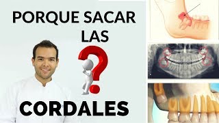 ✅ ¿Porque se extraen las cordales o muelas de juicio Dr Juan Tobar [upl. by Yna]