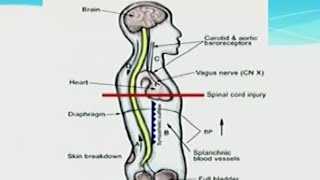 Autonomic Dysreflexia [upl. by Baruch]