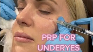 Undereye PRP Injections [upl. by Gaylor]