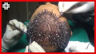 Hair Transplant Surgery 2018 [upl. by Erkan]