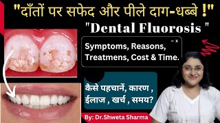 Dental Fluorosis Treatment Cost Home Remedies White Spots On Teeth दाँतों पर सफेद धब्बे [upl. by Pero]