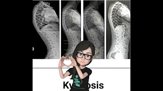 Scheuermanns Kyphosis [upl. by Jacey]