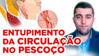 Carótidas e sua relação com a má circulação no cérebro AVC infarto trombose e artérias entupidas [upl. by Imot481]