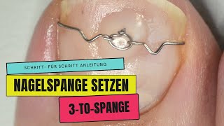 NAGELSPANGE  3 TO Spange bei EINGEWACHSENEN NÄGELN und ROLLNÄGELN anwenden [upl. by Radbun]