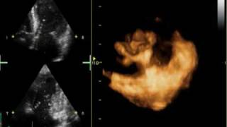 3D MITRAL REGURGITATION PROLAPSE P2 AND P3 [upl. by Cirad205]