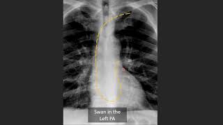 Swan Ganz Catheter Positioning on CXR [upl. by Violante]