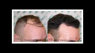 Trapianto di capelli FUE 3050 grafts [upl. by Hsirk]