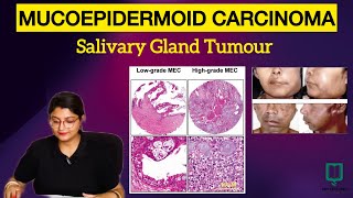 Mucoepidermoid Carcinoma  Lecture 42  Salivary Gland Tumour  Oral Pathology  BDS  MDS  NEETMDS [upl. by Esilegna]