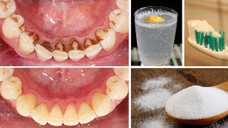 How To Remove Plaque From Teeth At Home Naturally [upl. by Pease]