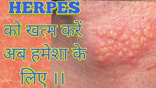 Herpes Treatment by the Simplest way by Asy Tips [upl. by Yzzik]