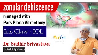 Zonular dehiscence managed with pars plana vitrectomy cataractsurgery sudhireyecoach [upl. by Nolava506]