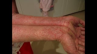 Treatment of eczema and other skin diseases [upl. by Naillimxam476]