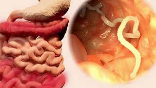 How to Get Rid of Intestinal Parasites recipe  Home Remedies [upl. by Reniti]