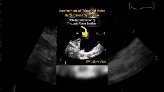 Involvement of Tricuspid Valve in Carcinoid Syndrome echocardiography [upl. by Jaf]