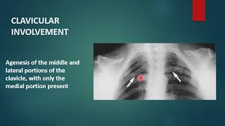 CLEIDOCRANIAL DYSPLASIA  Xray  Radiology [upl. by Odlonra]