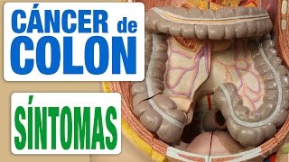 Cáncer de Colon  Síntomas [upl. by Monroy374]