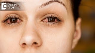 5 Causes of Eye Twich  Dr Sriram Ramalingam [upl. by Bicknell923]