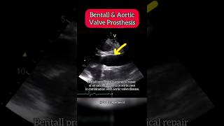 Bentall and aortic Valve Prosthesis on Echocardiography aortic Heart [upl. by Ramel]