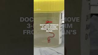 Worm removed from womans brain [upl. by Hendrix]