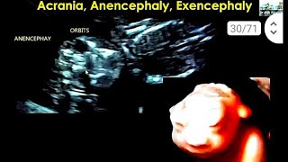 anencephaly 16 सप्ताह के बच्चे का हेडब्रेन brain 🧠 का नही बनना [upl. by Westerfield]