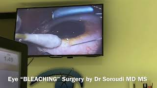 Eye Bleaching Surgery for Racial Melanosis Dr Ebbie Soroudi MD MS [upl. by Julina]