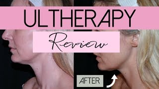 Ultherapy  NonInvasive Face Lift Treatment  Review  BusbeeStyle TV [upl. by Lole]