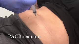 Lipolysis Injections Dr Sharabi PACBocacom [upl. by Gurias718]