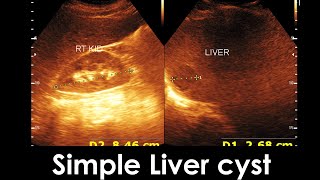 Simple Liver cyst  Enlarge prostate  Practical case [upl. by Korey]