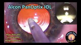 is the Alcon PanOptix trifocal IOL the best choice for cataract surgery [upl. by Itsrik135]