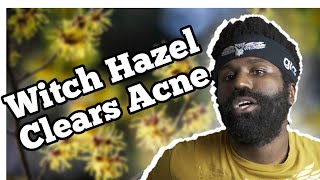 6 Ways Witch Hazel Can GET RIDE OF YOUR ACNE [upl. by Mylo]