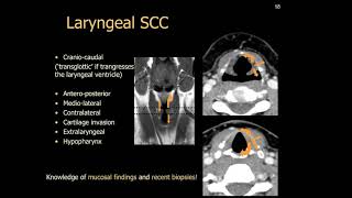 Imaging of larynx [upl. by Kceb835]