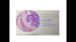 Adenoid cystic carcinoma [upl. by Benedetto]