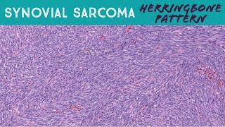 Synovial sarcoma monophasic with classic quotherringbonequot pattern soft tissue pathology [upl. by Luke854]