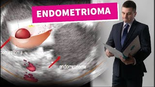 Endometrioma  cisto de ovário da endometriose [upl. by Enitsyrk131]