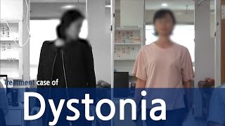 Cervical Dystonia  Dystonia  Spasmodic Torticollis  사경증 치료사례  근긴장이상증 [upl. by Metah]