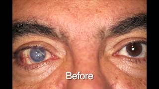 Custom Color Contacts  Prosthetic Before and Afters [upl. by Ainoet983]