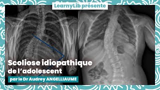 🩺 Pédiatrie  la scoliose idiopathique de ladolescent avec le Dr Audrey ANGELLIAUME [upl. by Juanita171]