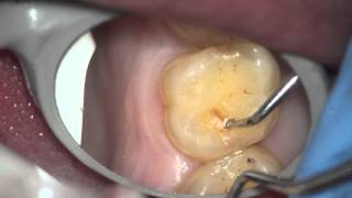 A hole in tooth where a filling use to be [upl. by Efrem]