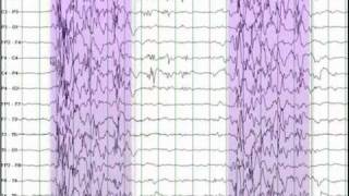 EEG Reading Rounds Burst Suppression [upl. by Newcomer323]