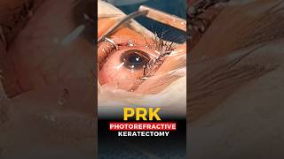 Live Photorefractive Keratectomy PRK Surgery [upl. by Allit502]